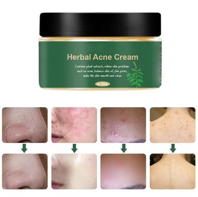 Organic Herbal Anti Acne Remover Pimple Treatment Repair Scar Cream