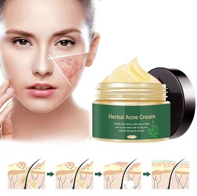 Organic Herbal Anti Acne Remover Pimple Treatment Repair Scar Cream