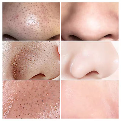 Blackhead Remover Face Serum Natural Organic Anti Aging Repair Skin Care Serum