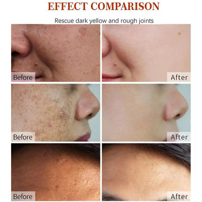 Face Black Freckle Acne Fade Dark Spot Removing Corrector Whitening Cream