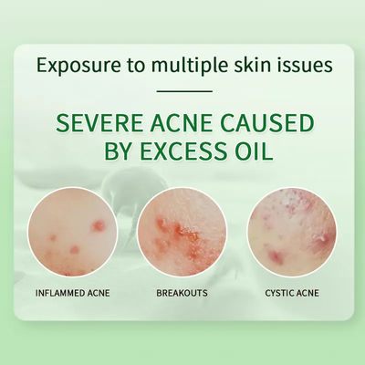 Deep Cleaning Anti-Acne Repair Fade Acne Mark Acne Treatment Cream